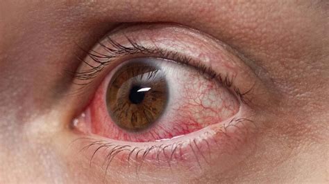 Can Heat Cause Red Eyes at Chloe Dunbar blog