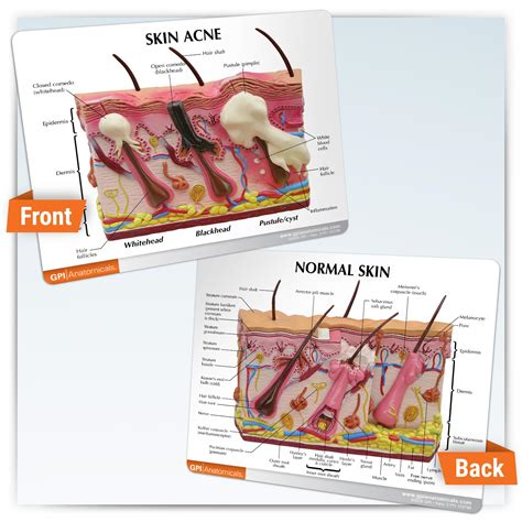 GPI Anatomicals - Skin Acne Model, Cross-Section India | Ubuy