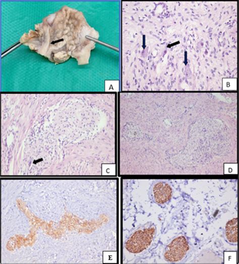 Sporadic diffuse gastric ganglioneuromatosis causing gastric outlet ...