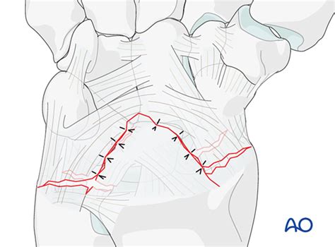 Image result for Lunate Dislocation Reduction