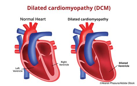 Icd Ventricular Heart Failure at Paulette Reynolds blog