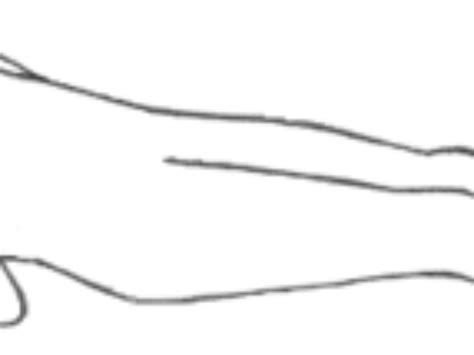 Image result for Decorticate Posture