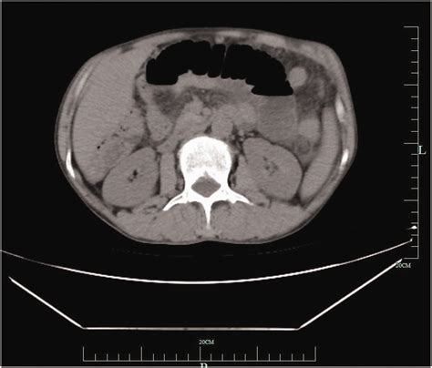 Retroperitoneal lymph node tuberculosis complicated by intestinal obstruction: a case report ...