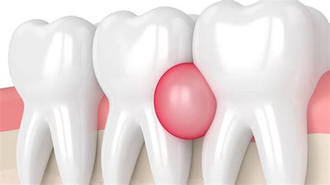 Gum Abscess Popped: Relief vs Danger + What to Do Next