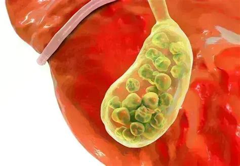 FIB-4 Score Positively Linked to Gallstone Risk in US Adults, confirms ...