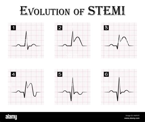 What Is St Elevation Myocardial Infarction - Design Talk