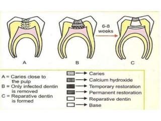 Image result for Difference Between Direct and Indirect Pulp Capping