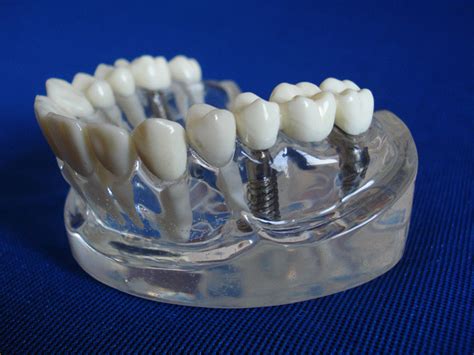 韩国纯钛种植牙多少钱一颗2022价格表更新,含加全瓷牙冠价格,种植牙-8682赴韩整形网