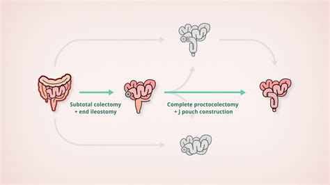 Patient Teaching: Surgical treatment for ulcerative colitis - TVASurg ...
