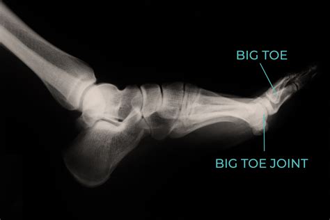 Turf Toe Anatomy Big Toe Joint Pain Sesamoiditis Ohio Podiatric Care