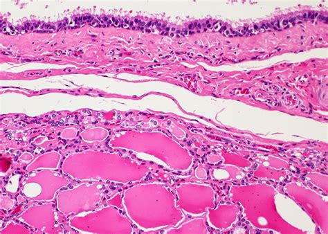 Thyroglossal Duct Cyst Histology Thyroglossal Duct Anomalies In