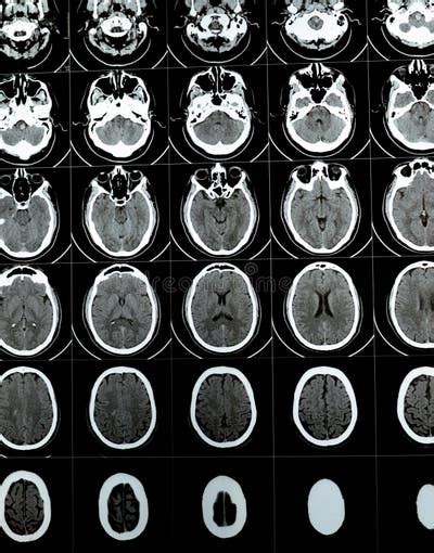Image result for Normal Brain CT Scan