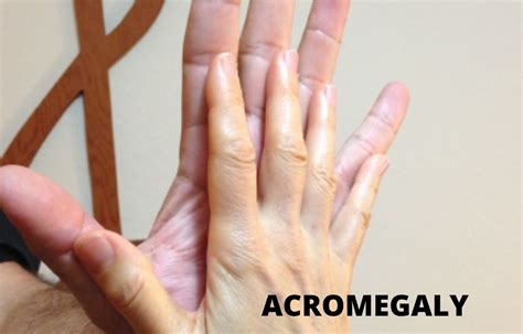 Paltusotine found safe, effective among patients with acromegaly in ...