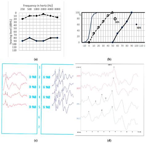 Pathophysiology of Postoperative Hearing Disorders after Vestibular ...