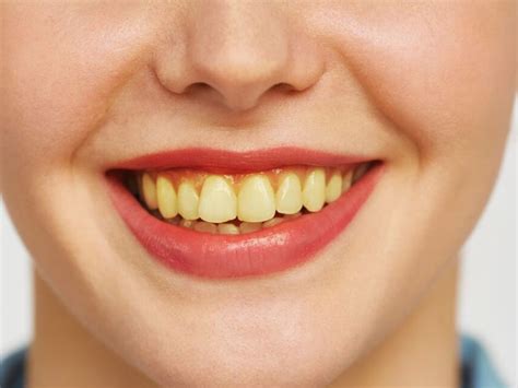 Oral Health: If the yellowness of teeth has taken away the smile from ...