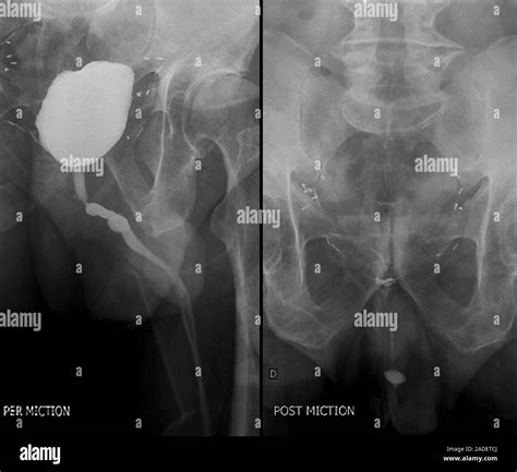 Bladder after prostate removal. X-rays of a section through the pelvis of a 66-year-old male ...