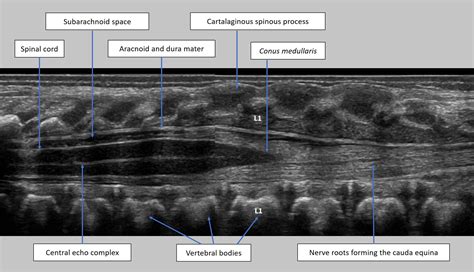 Sacral Dimple Ultrasound