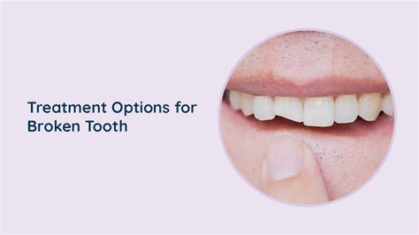 Can a Broken Tooth Be Saved? What You Need to Know