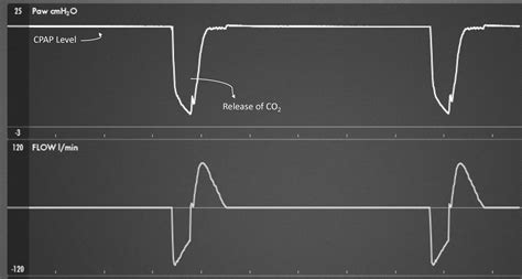 Airway Pressure Release Ventilation - Emergency Medicine Clinics