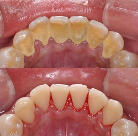 牙科袪牙结石多久去一次比较好?一般要多少钱-爱康健齿科
