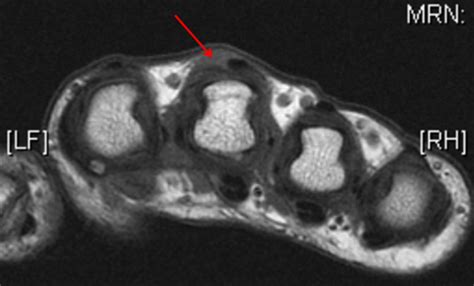 Sagittal Band Rupture - Hand - Orthobullets