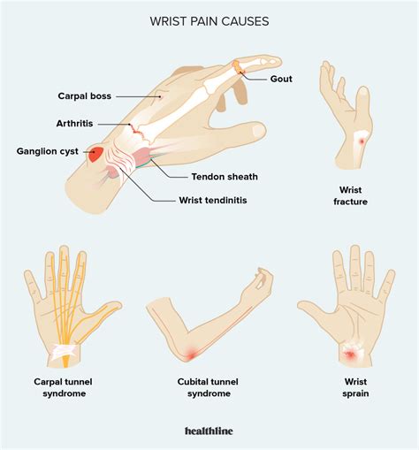 Wrist Pain Pinky Side Swelling at Ricardo Watkins blog
