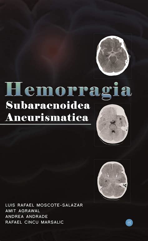 Hemorragia Subaracnoidea Aneurismatica : Amit Agrawal: Amazon.in: Books