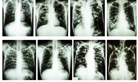 Lower dose of Pirfenidone as effective as full dose for reducing ...