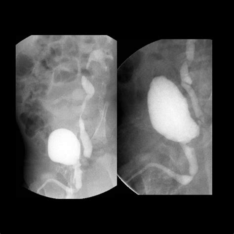 Infant with a urinary tract infection | Pediatric Radiology Case ...