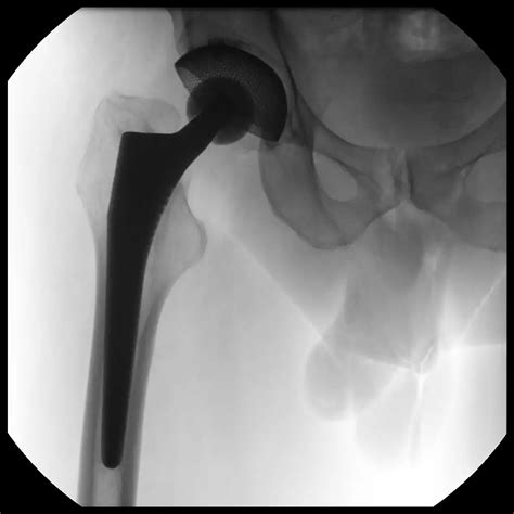 Philips - Zenition 90 - Mobile C-arm with flat detector