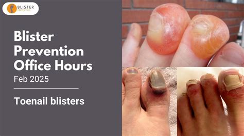 Toenail Blisters - What Causes Subungual and Periungual Blisters - Blister Prevention Pro