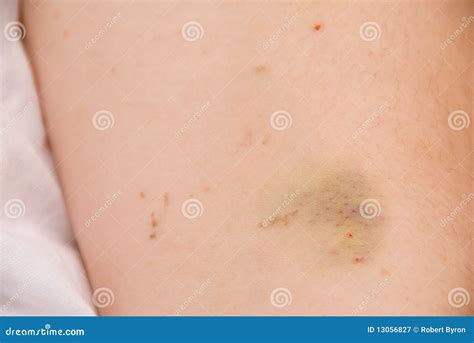 IV Bruise stock image. Image of injury, discoloration - 13056827