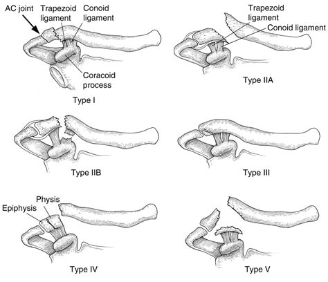Clavicle Fractures - Distal - Trauma - Orthobullets