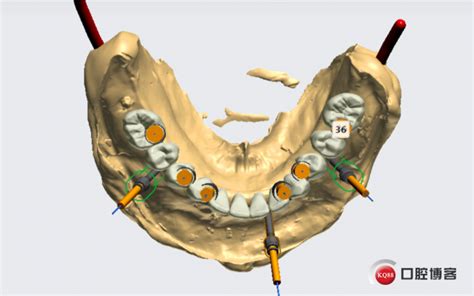 下颌四颗osstem种植体，杆卡联合Locator基台修复-牙医关鑫的博客-KQ88口腔博客