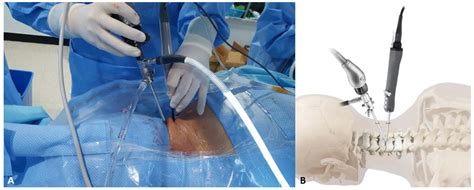Comparison of Cervical Biportal Endoscopic Spine Surgery and Anterior Cervical Discectomy and ...