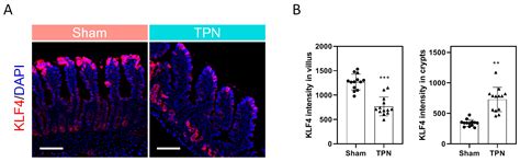 Decreased Expression of KLF4 Leading to Functional Deficit in Pediatric ...