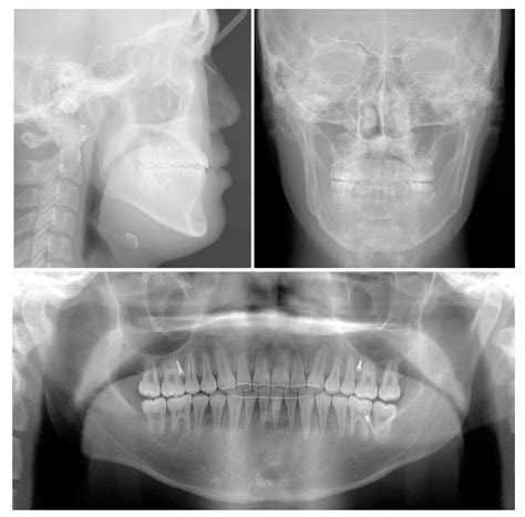 Non-Surgical Camouflage Treatment of a Skeletal Class III Patient with ...