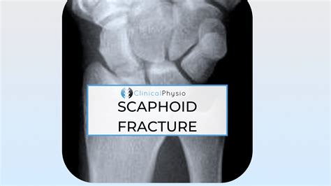 Scaphoid Fractures – Clinical Physio Membership