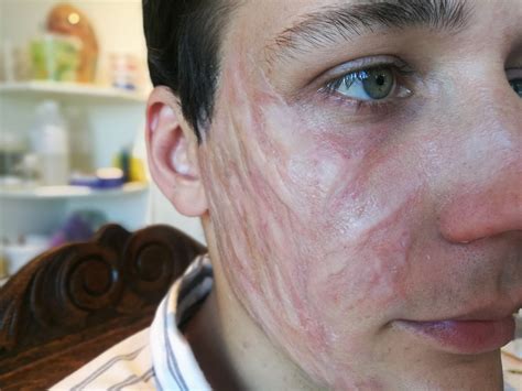 Washcloth Burn On Face at Samantha Hanlon blog