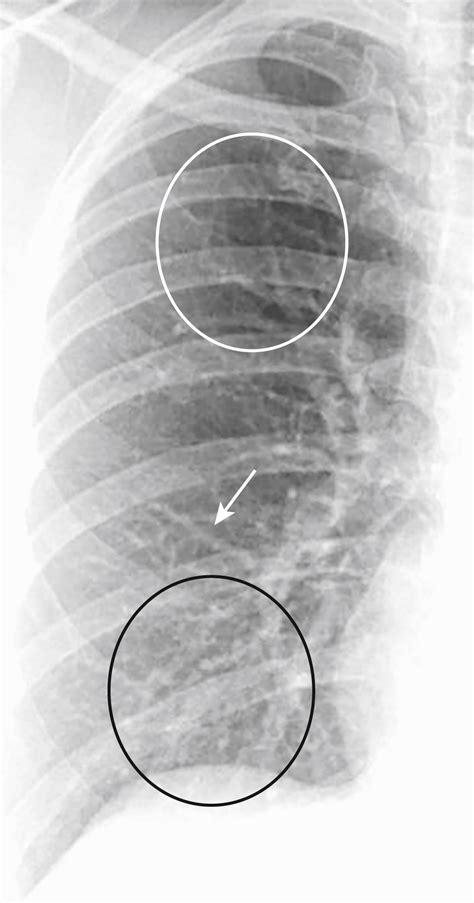 Image result for Poumon Normal Scanner