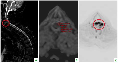 Whole-Body MRI with Diffusion-Weighted Imaging in Bone Metastases: A ...