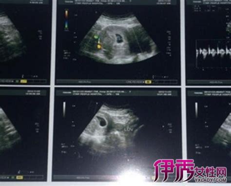 西京医院产科病例分享（十九）---TTTS患者胎儿镜术后顺利分娩（2016胎儿镜收官之作）