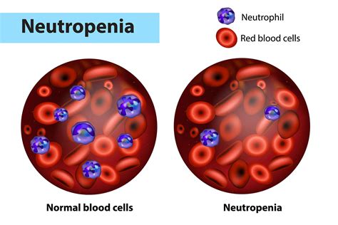 Neutropenia: Causes, Symptoms, and Treatment