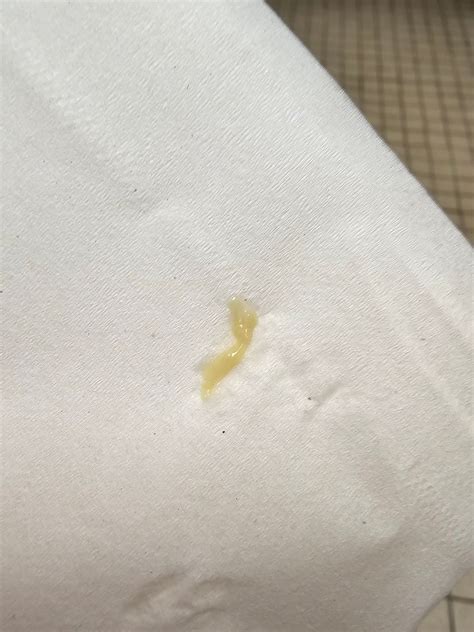 Yellow Mucous Discharge | BabyCenter