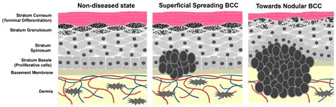 Hedgehog Signaling for Basal Cell Carcinoma | Encyclopedia MDPI