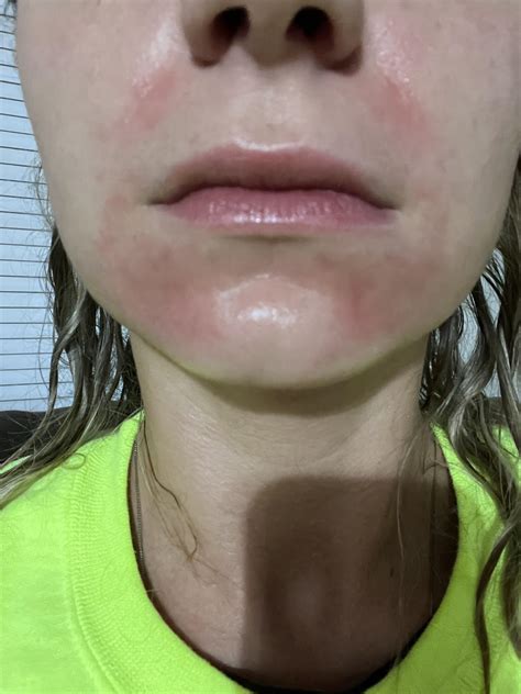 Rosacea? Constant redness in this area when I do not tan. I have had this for years, I do not ...