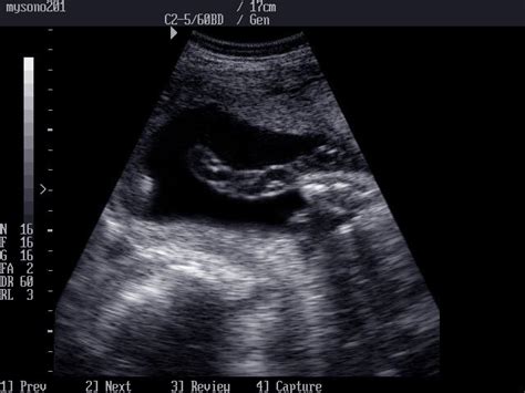 Bildergebnis für normal umbilical cord ultrasound