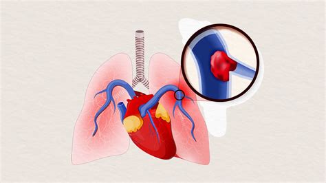 Diagnosed With a Blood Clot — What Should I Do Now?