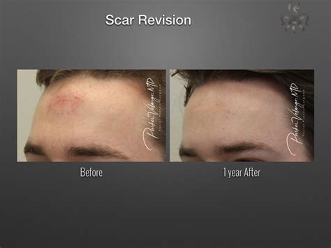 Scar Revision | Keloid Treatment | New Orleans Center for Aesthetics ...