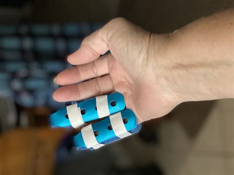 Trigger Finger Causes, Symptoms & Treatment | Advanced Surgery Center